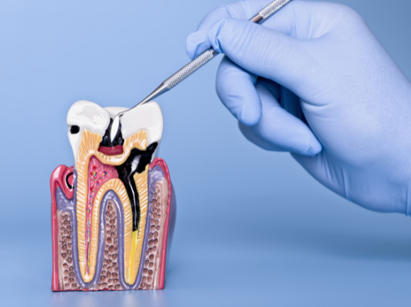 CARIE come si formano e come prevenirle