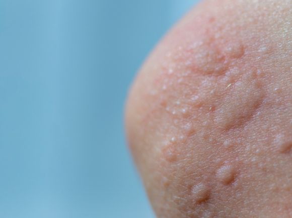 ORTICARIA : Cos'è, le tipologie e come 'curarla'